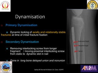Dynamisation
 Primary Dynamisation
 Dynamic locking of axially and rotationally stable
fractures at time of initial frac...