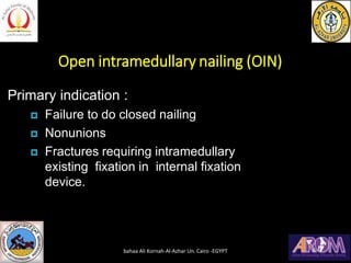 Open intramedullary nailing (OIN)
Primary indication :
 Failure to do closed nailing
 Nonunions
 Fractures requiring in...