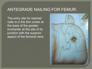 Intramedullary Nailing Seminar By Dr Ashwani Panchal