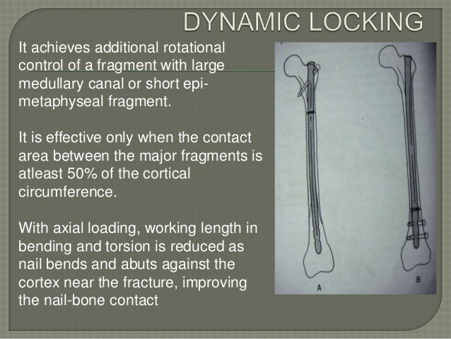 Intramedullary Nailing Seminar By Dr Ashwani Panchal - 
