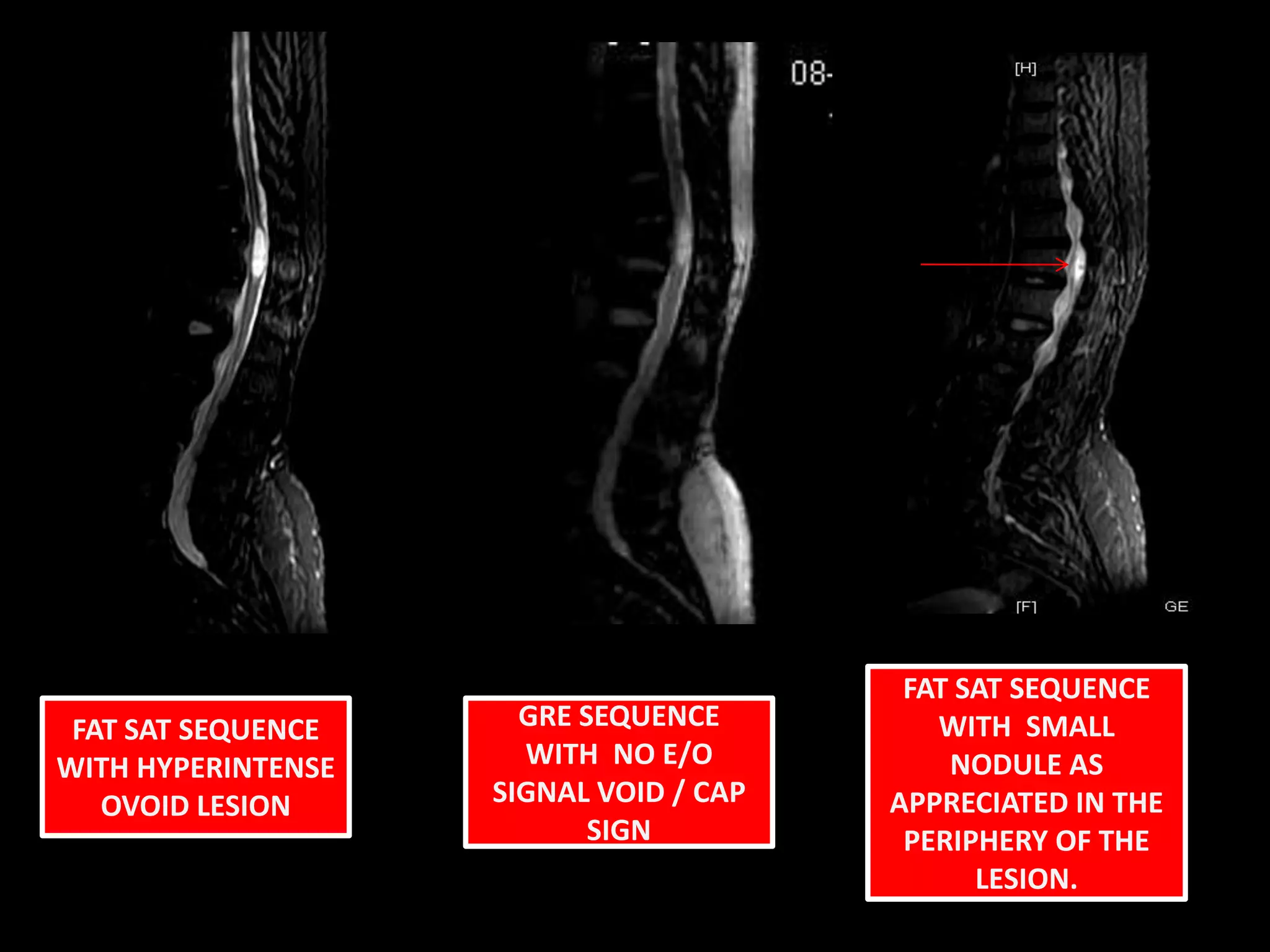 FAT SAT SEQUENCE WITH  SMALL NODULE AS APPRECIATED IN THE PERIPHERY OF THE LESION.FAT SAT SEQUENCE WITH HYPERINTENSE OVOID LESIONGRE SEQUENCE WITH  NO E/O SIGNAL VOID / CAP SIGN