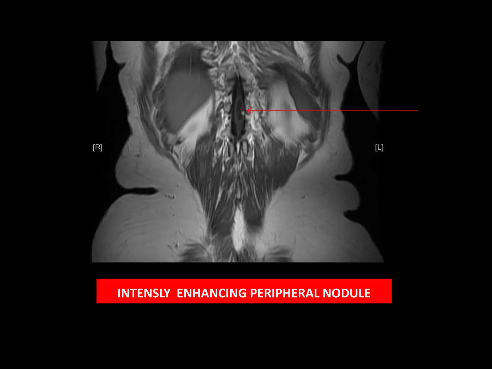 INTENSLY  ENHANCING PERIPHERAL NODULE 