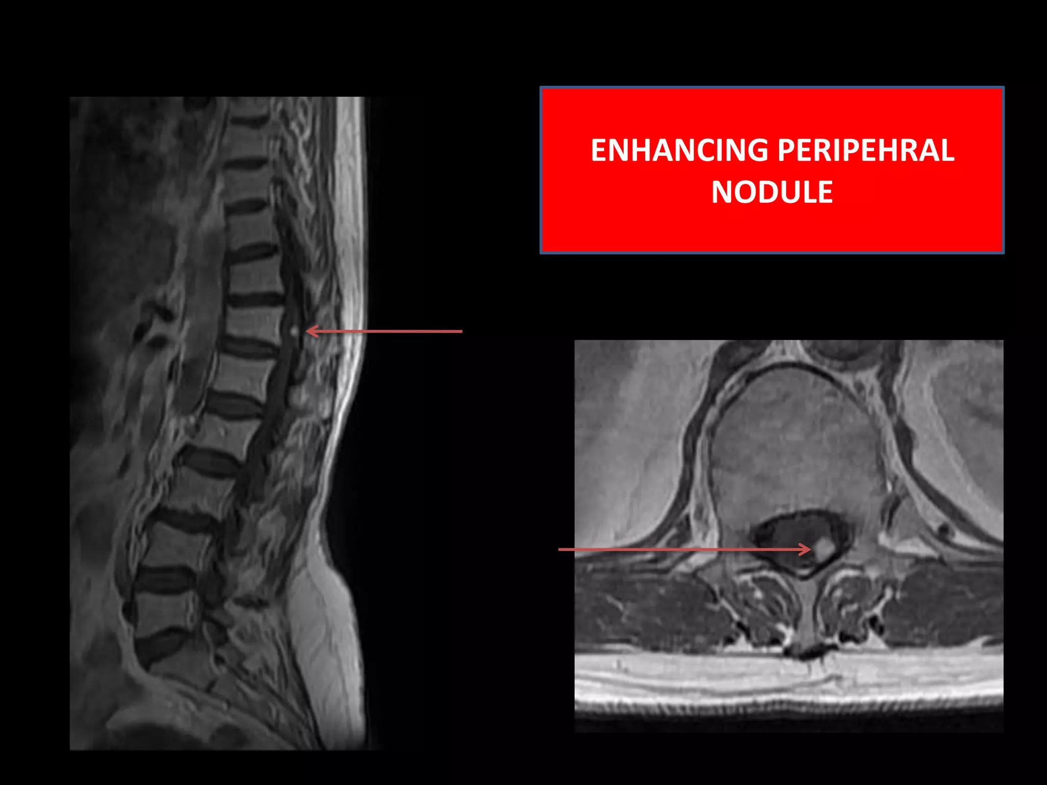 ENHANCING PERIPEHRAL NODULE 