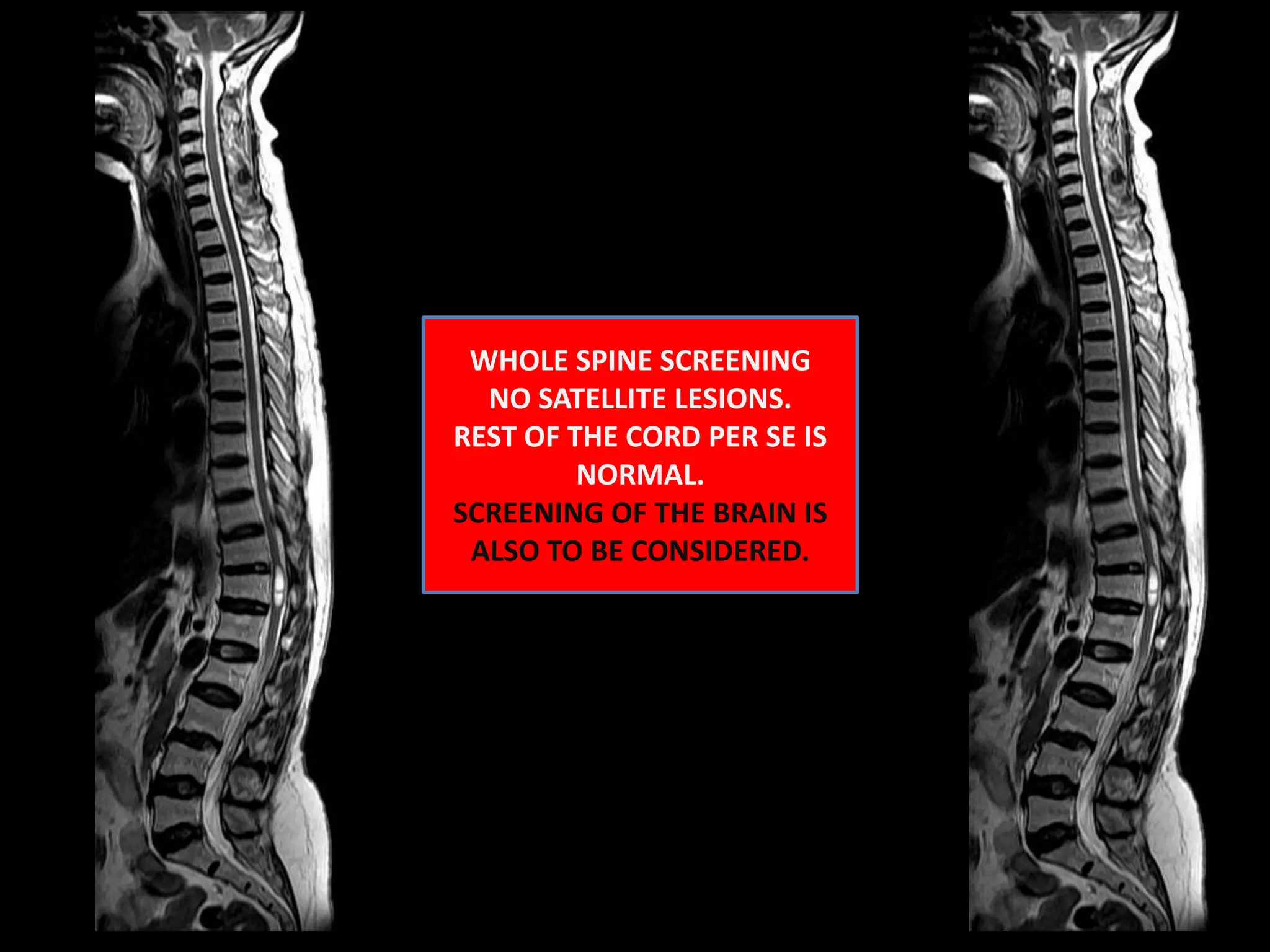 WHOLE SPINE SCREENING NO SATELLITE LESIONS.REST OF THE CORD PER SE IS NORMAL.SCREENING OF THE BRAIN IS ALSO TO BE CONSIDERED.