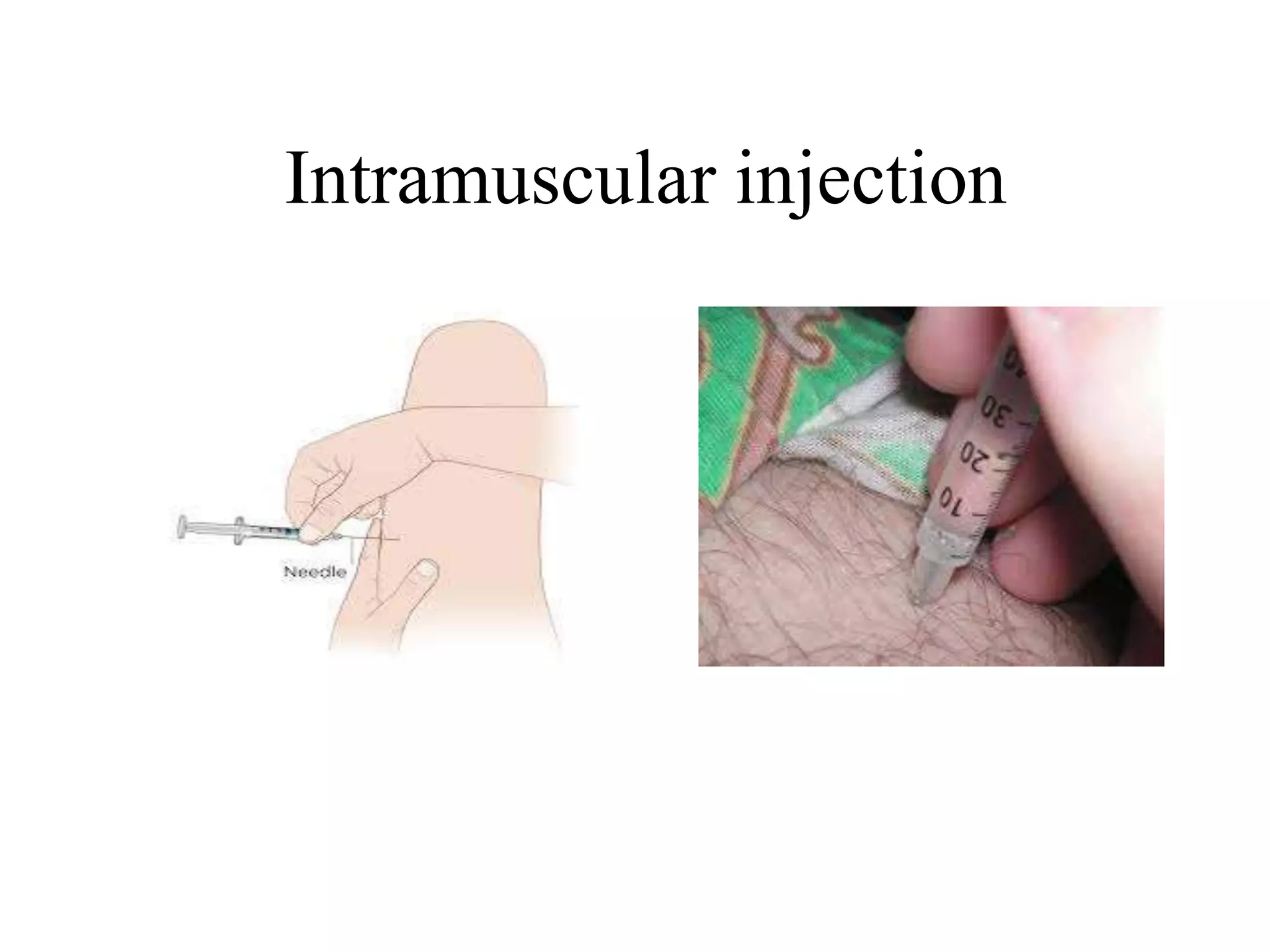 Intramuscular injection
 