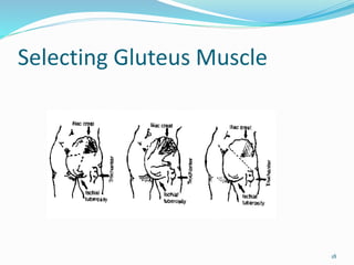 Selecting Gluteus Muscle
18
 