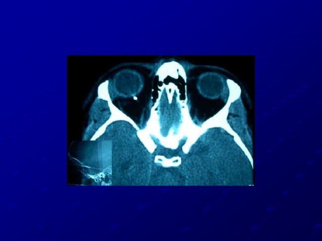 Intraocular foreign bodies - AJAY DUDANI | PPT | Death, Injury, or ...