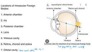 Locations of Intraocular Foreign
Bodies
1. Anterior chamber
2. Iris
3. Posterior chamber
4. Lens
5. Vitreous cavity
6. Retina, choroid and sclera
7. Orbital cavity
Inert
foreign
bodies
leg plastic): can be
left
-bones around artery
tests:Xray, CT
 
