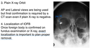 3. Plain X-ray Orbit
AP and Lateral views are being used
but final confirmation is required by a
CT scan even if plain X-ray is negative.
4. Localization of IOFB
Once foreign body is confirmed on
fundus examination or X-ray, exact
localization is important to plan proper
removal.
foreign
body
- - -
 