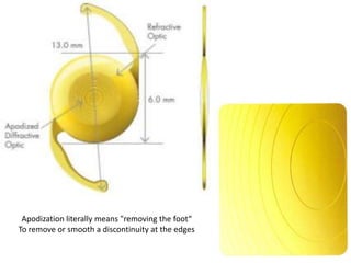 Intraocular lenses | PPTX