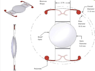 Intraocular lenses | PPTX