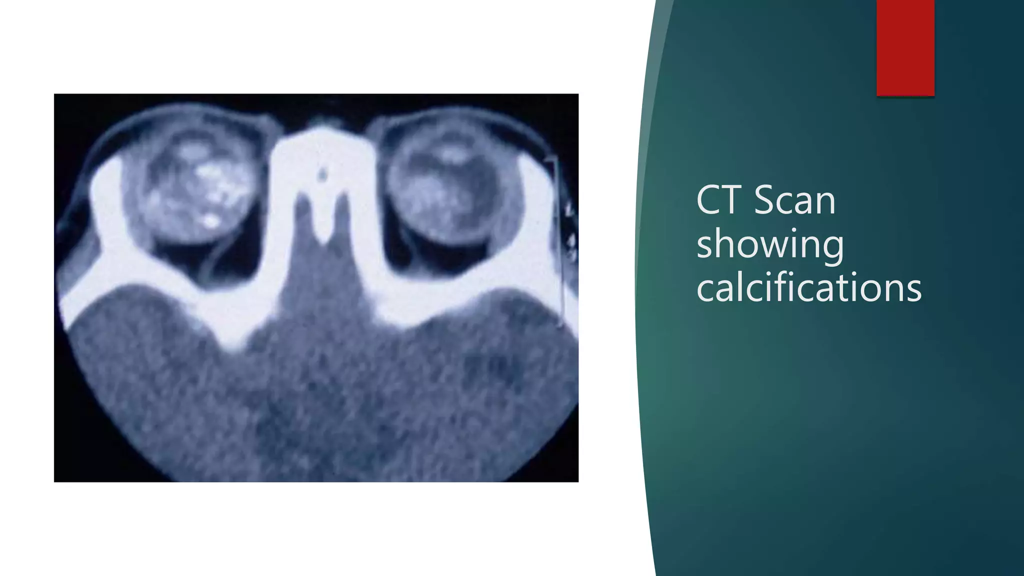 CT Scan
showing
calcifications
 