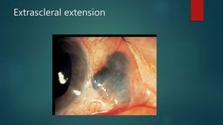 Extraocular Cancer Intraocular tumors | PPTX