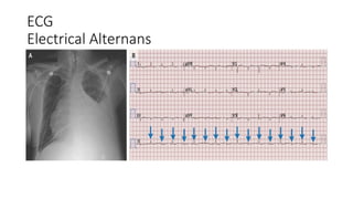 ECG
Electrical Alternans
 