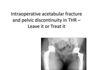 Intraoperative acetabular fracture
and pelvic discontinuity in THR –
Leave it or Treat it
 