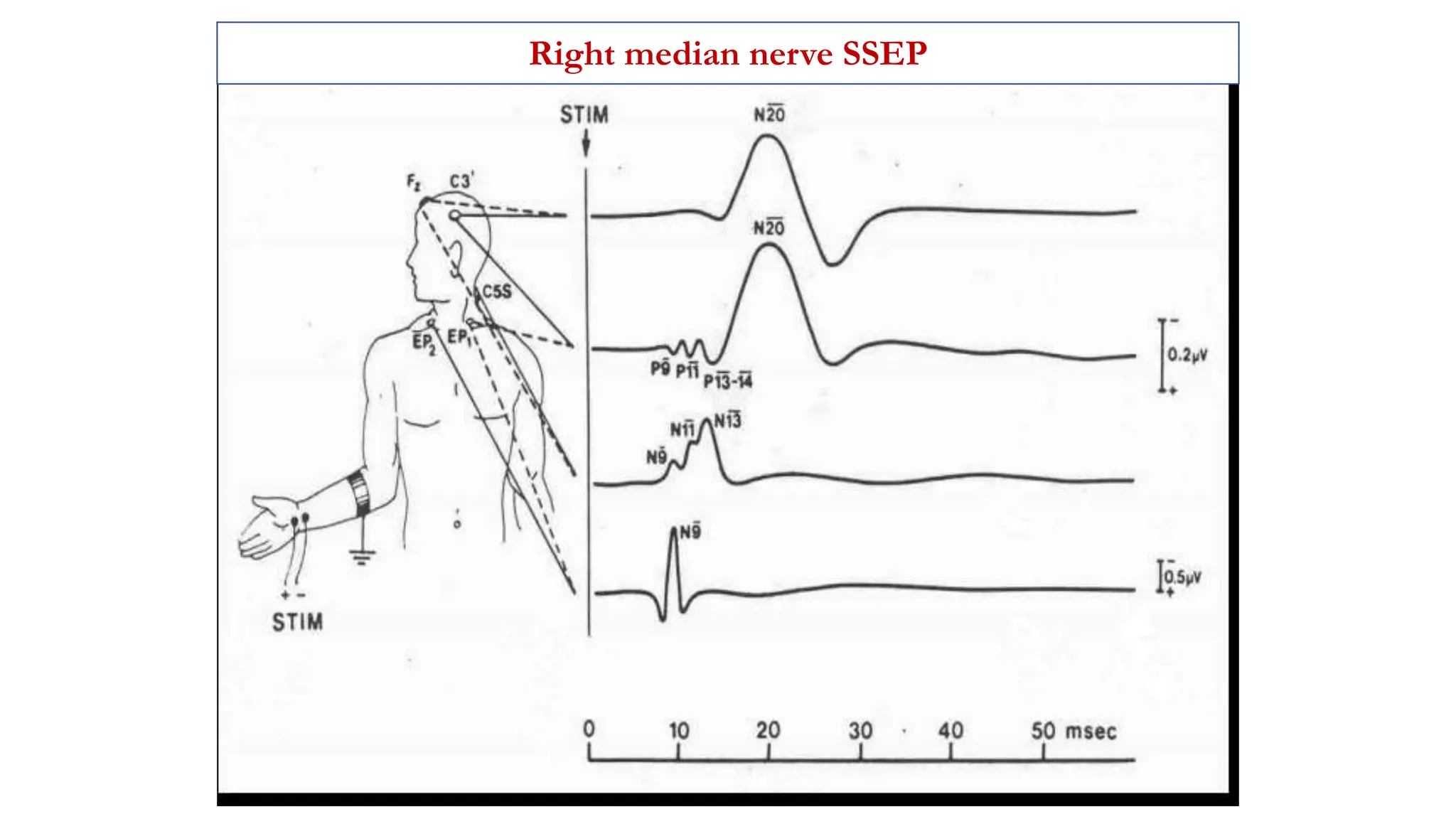 Right median nerve SSEP
 
