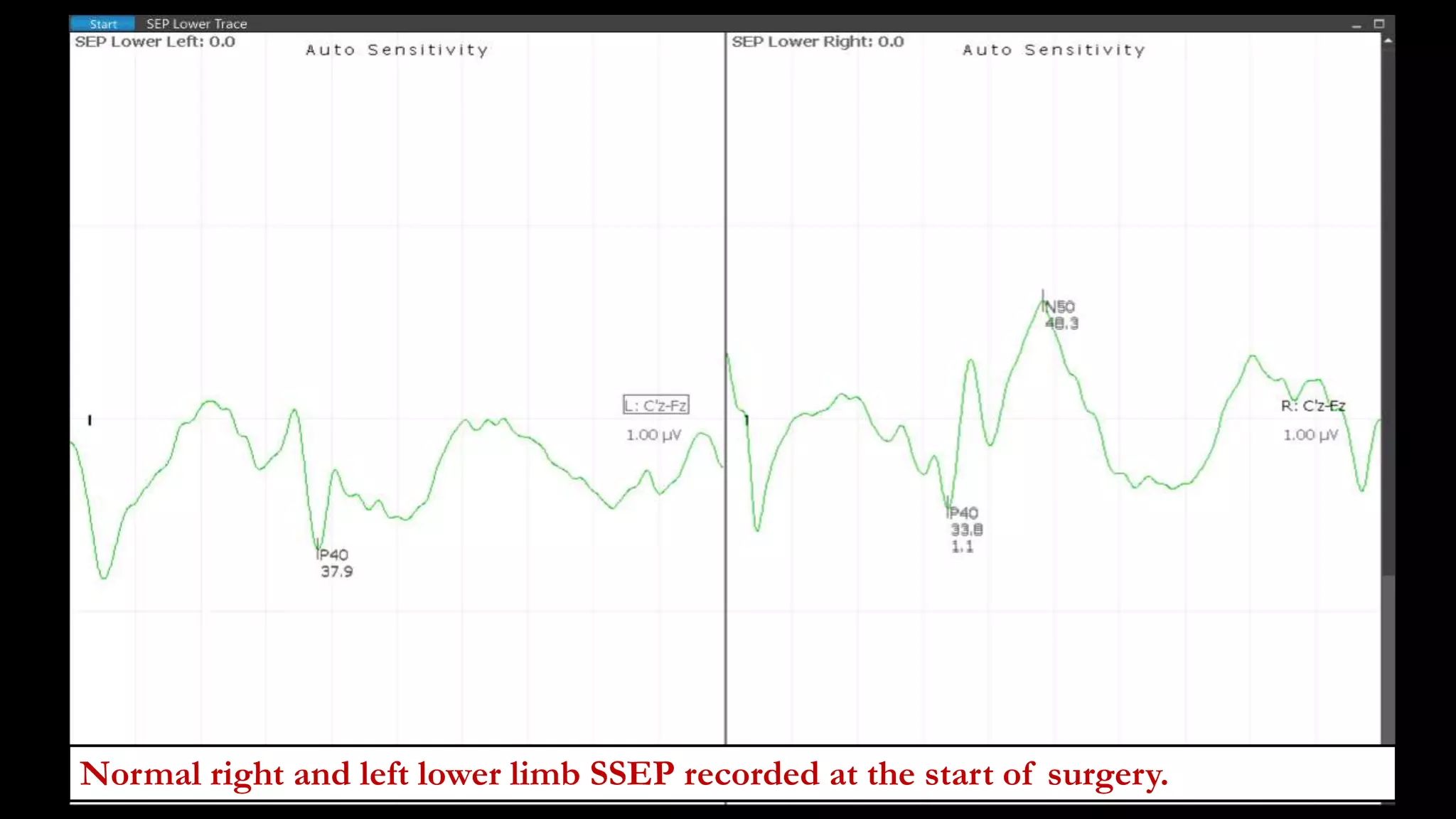 Normal right and left lower limb SSEP recorded at the start of surgery.
 
