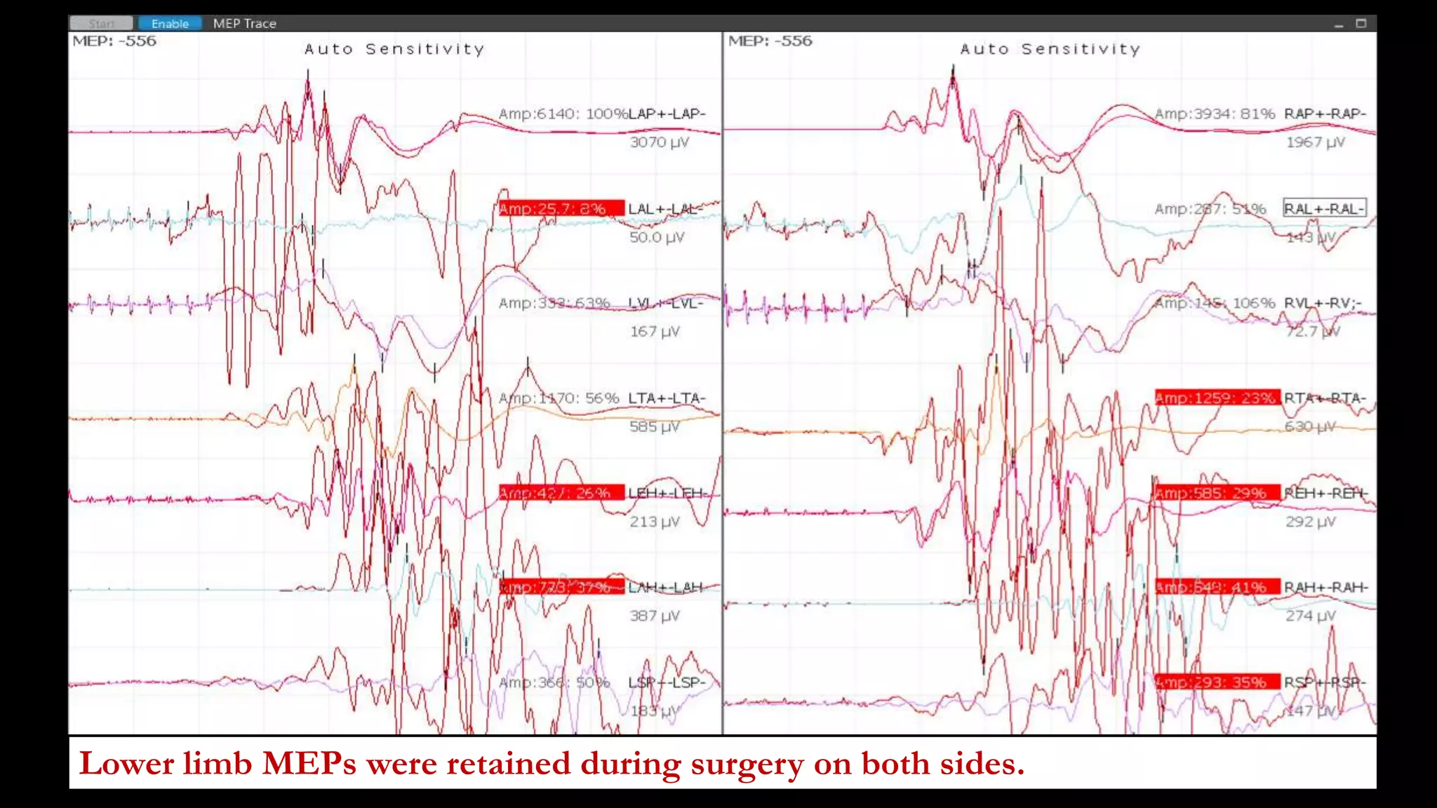 Lower limb MEPs were retained during surgery on both sides.
 