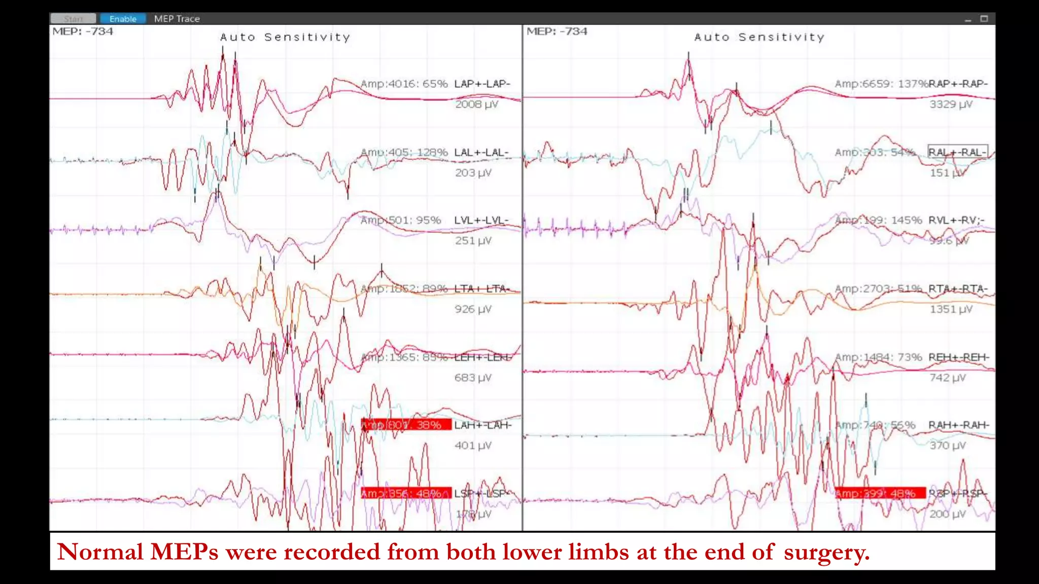 Normal MEPs were recorded from both lower limbs at the end of surgery.
 
