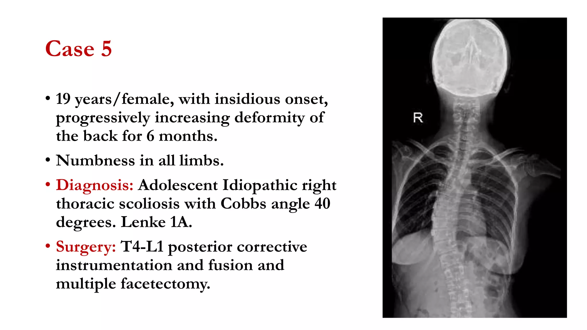 Case 5
• 19 years/female, with insidious onset,
progressively increasing deformity of
the back for 6 months.
• Numbness in all limbs.
• Diagnosis: Adolescent Idiopathic right
thoracic scoliosis with Cobbs angle 40
degrees. Lenke 1A.
• Surgery: T4-L1 posterior corrective
instrumentation and fusion and
multiple facetectomy.
 
