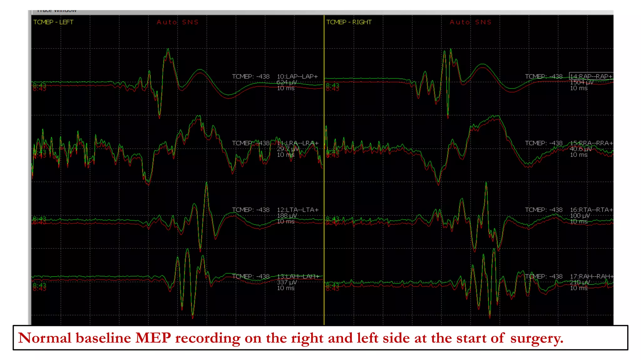 Normal baseline MEP recording on the right and left side at the start of surgery.
 