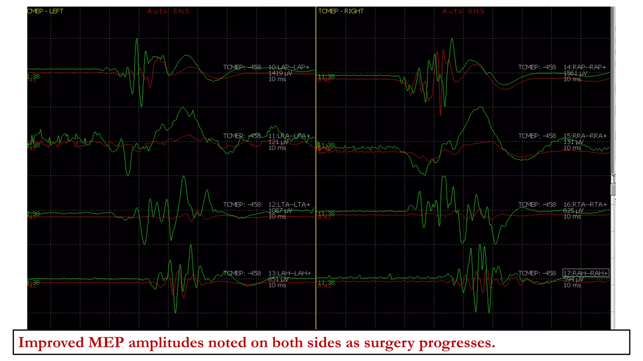 Improved MEP amplitudes noted on both sides as surgery progresses.
 