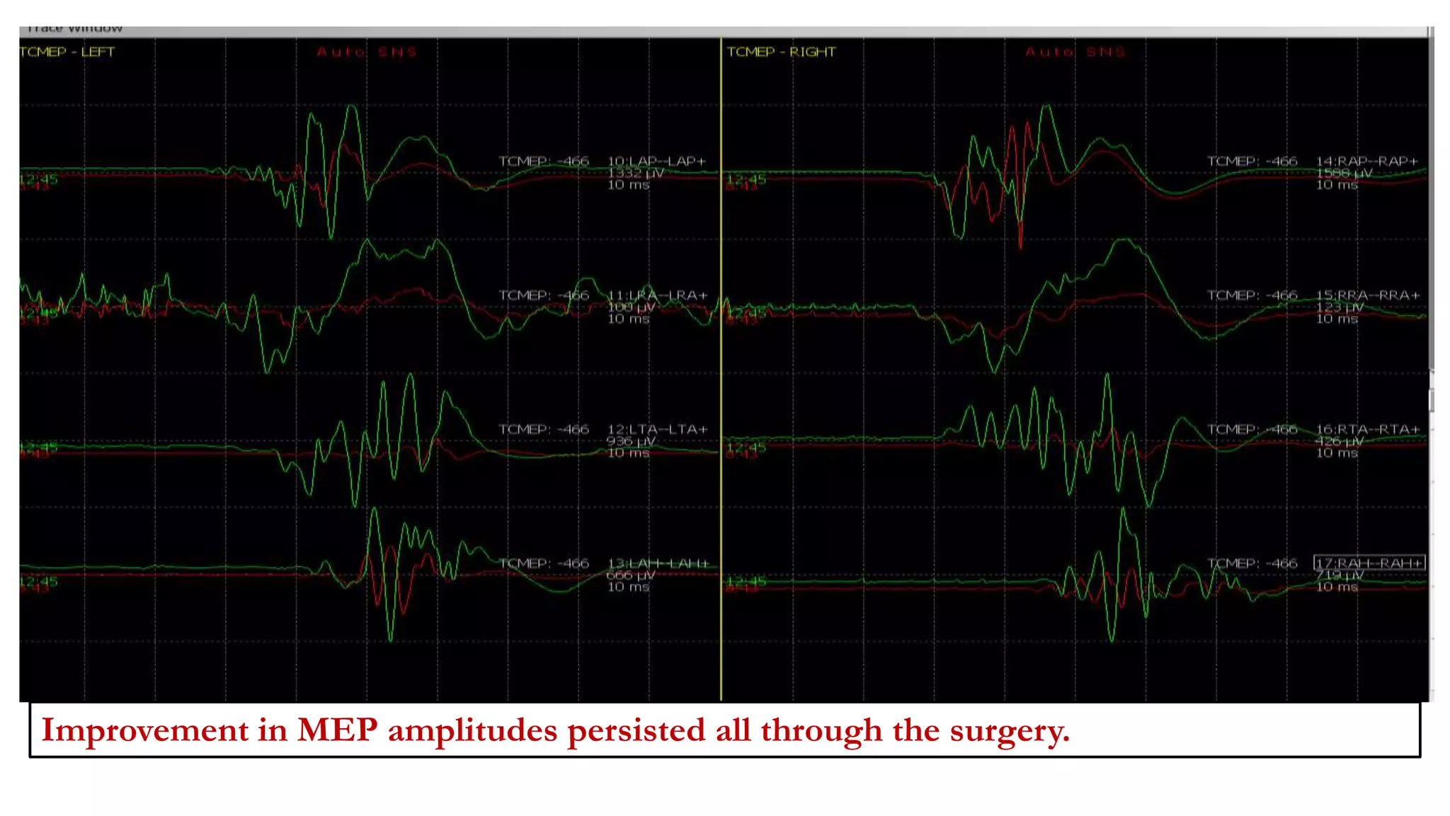 Improvement in MEP amplitudes persisted all through the surgery.
 