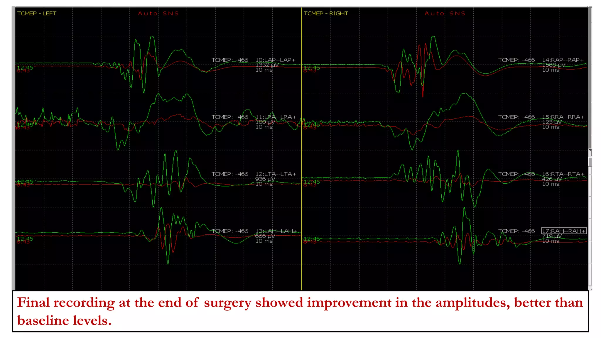 Final recording at the end of surgery showed improvement in the amplitudes, better than
baseline levels.
 
