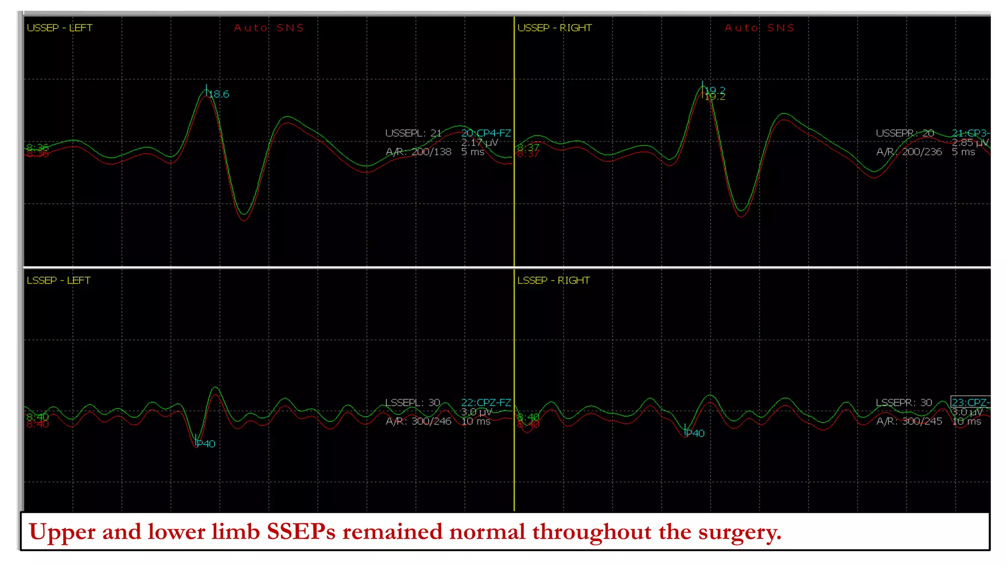 Upper and lower limb SSEPs remained normal throughout the surgery.
 