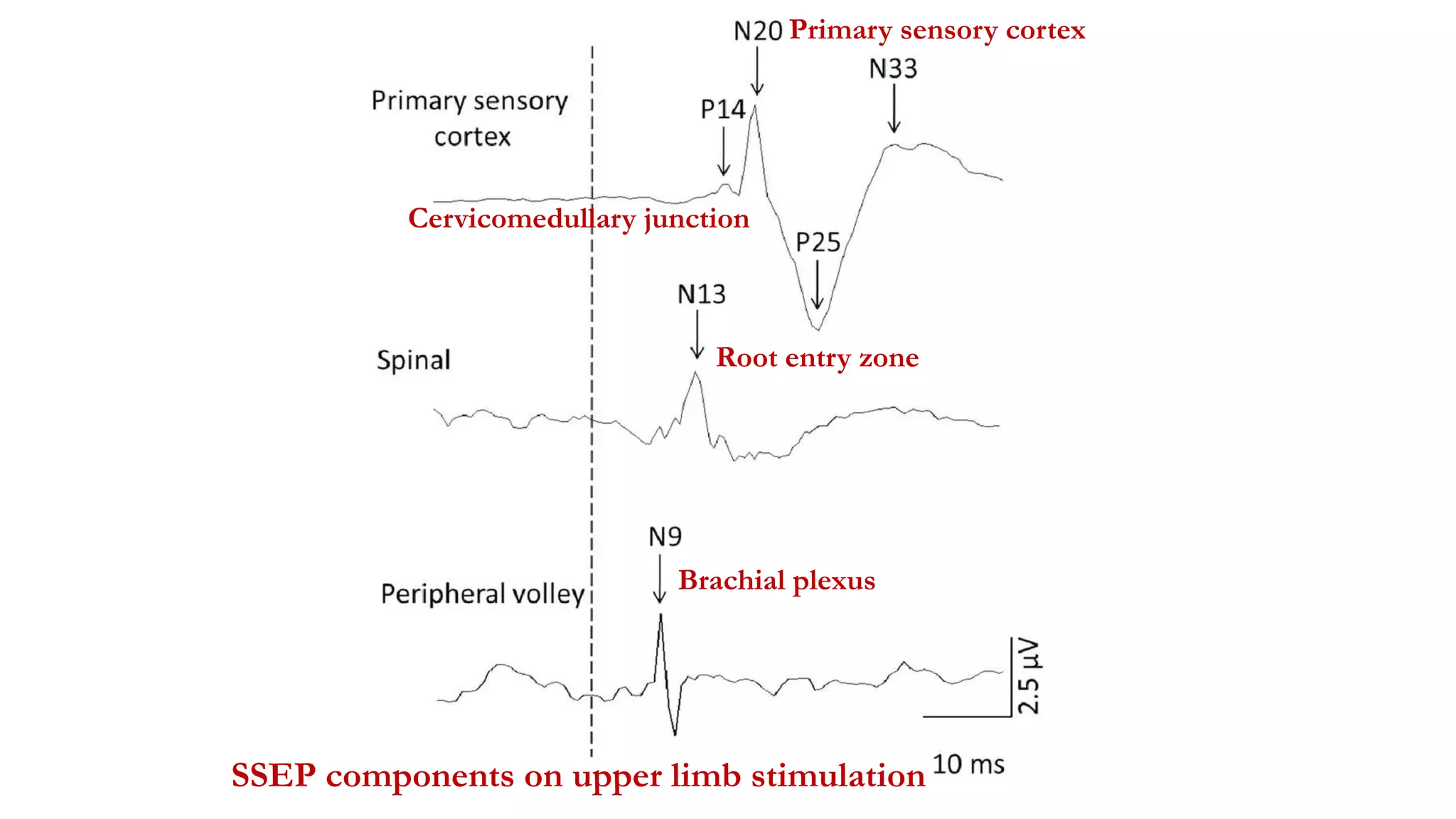 SSEP components on upper limb stimulation
Brachial plexus
Root entry zone
Cervicomedullary junction
Primary sensory cortex
 