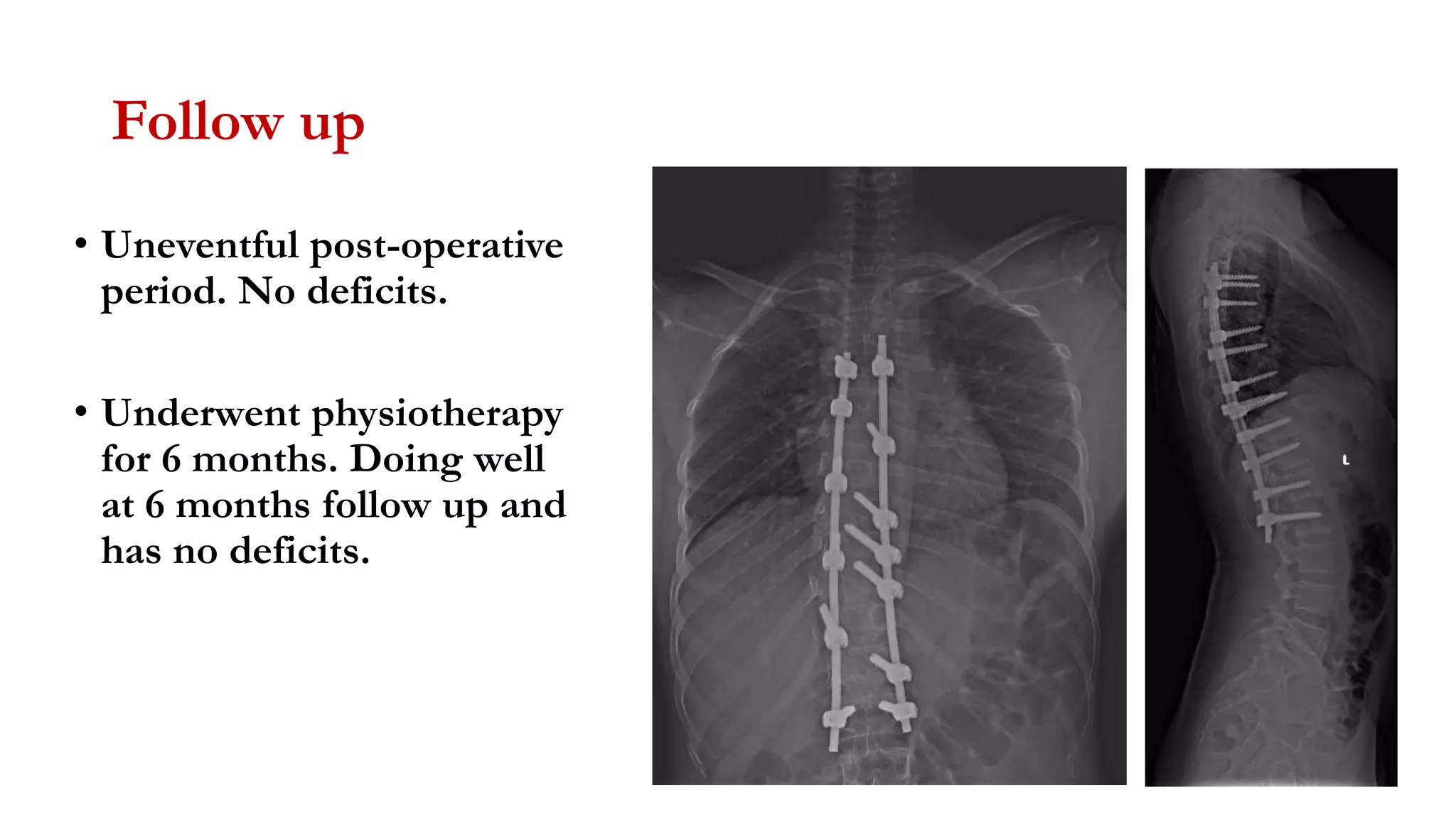 Follow up
• Uneventful post-operative
period. No deficits.
• Underwent physiotherapy
for 6 months. Doing well
at 6 months follow up and
has no deficits.
 