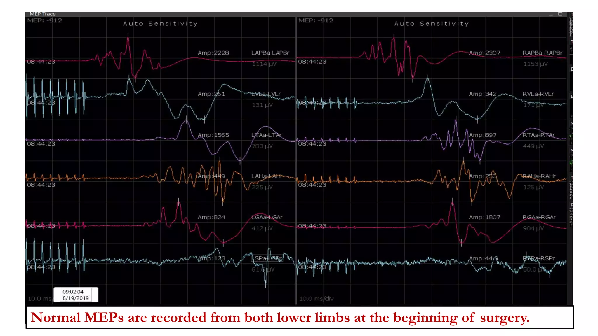 Normal MEPs are recorded from both lower limbs at the beginning of surgery.
 