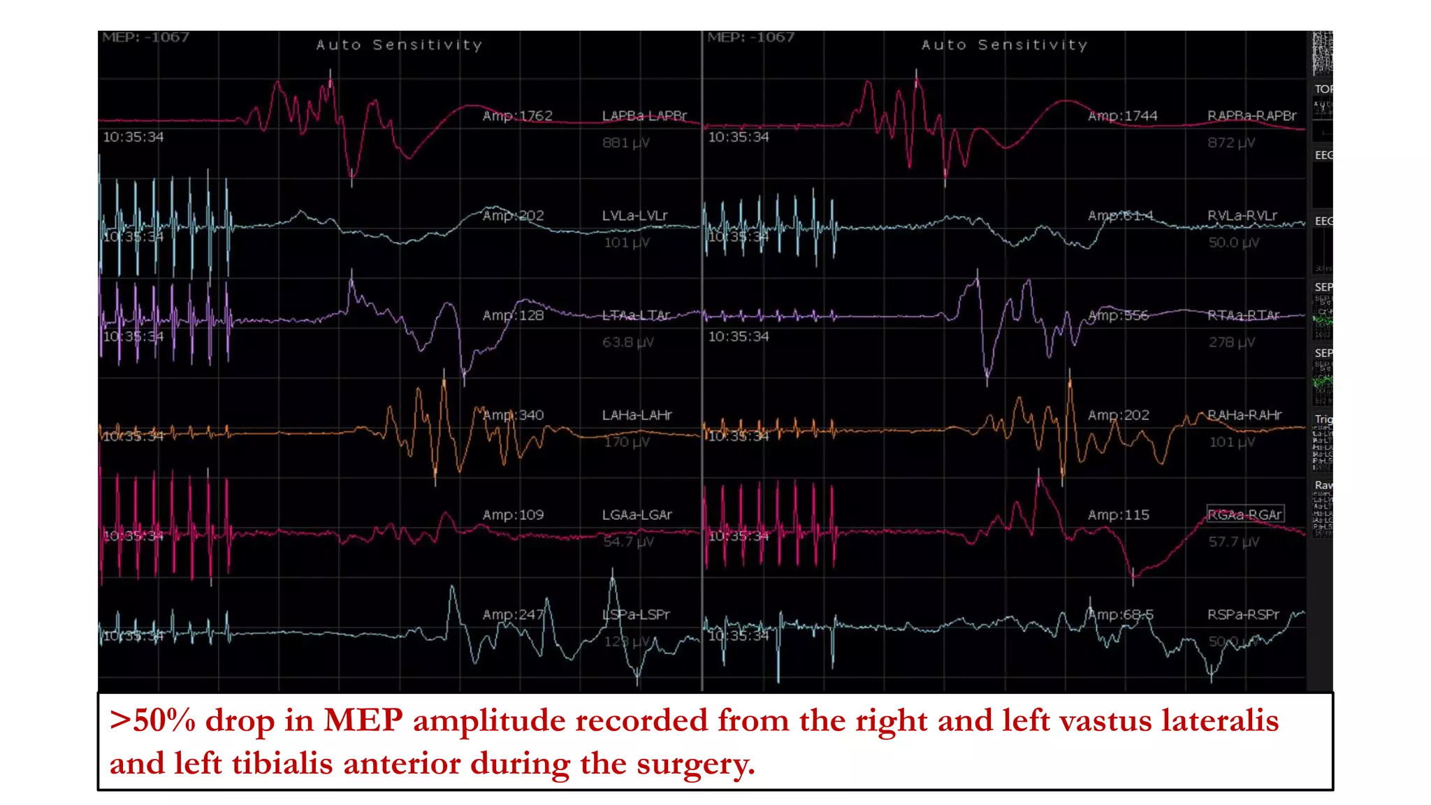 >50% drop in MEP amplitude recorded from the right and left vastus lateralis
and left tibialis anterior during the surgery.
 
