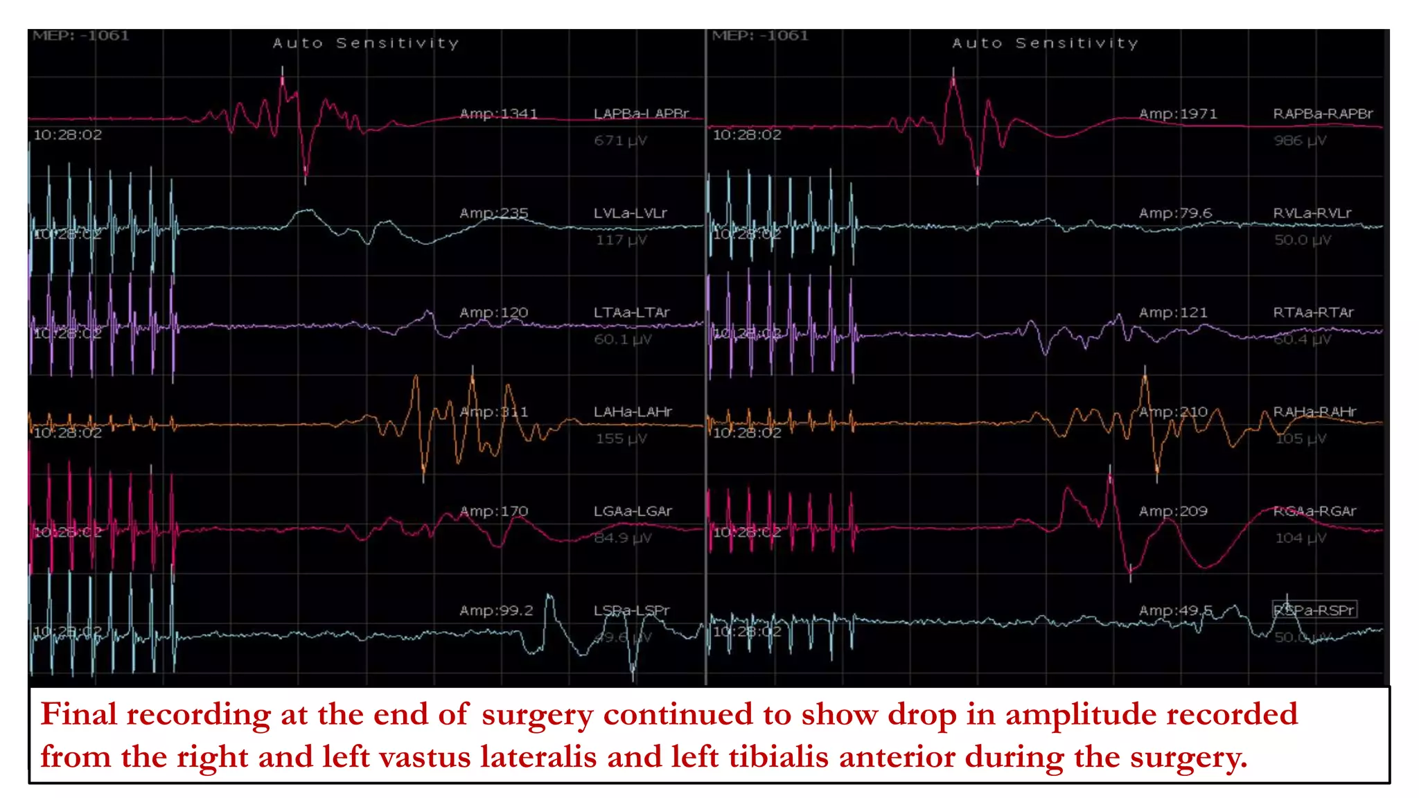Final recording at the end of surgery continued to show drop in amplitude recorded
from the right and left vastus lateralis and left tibialis anterior during the surgery.
 