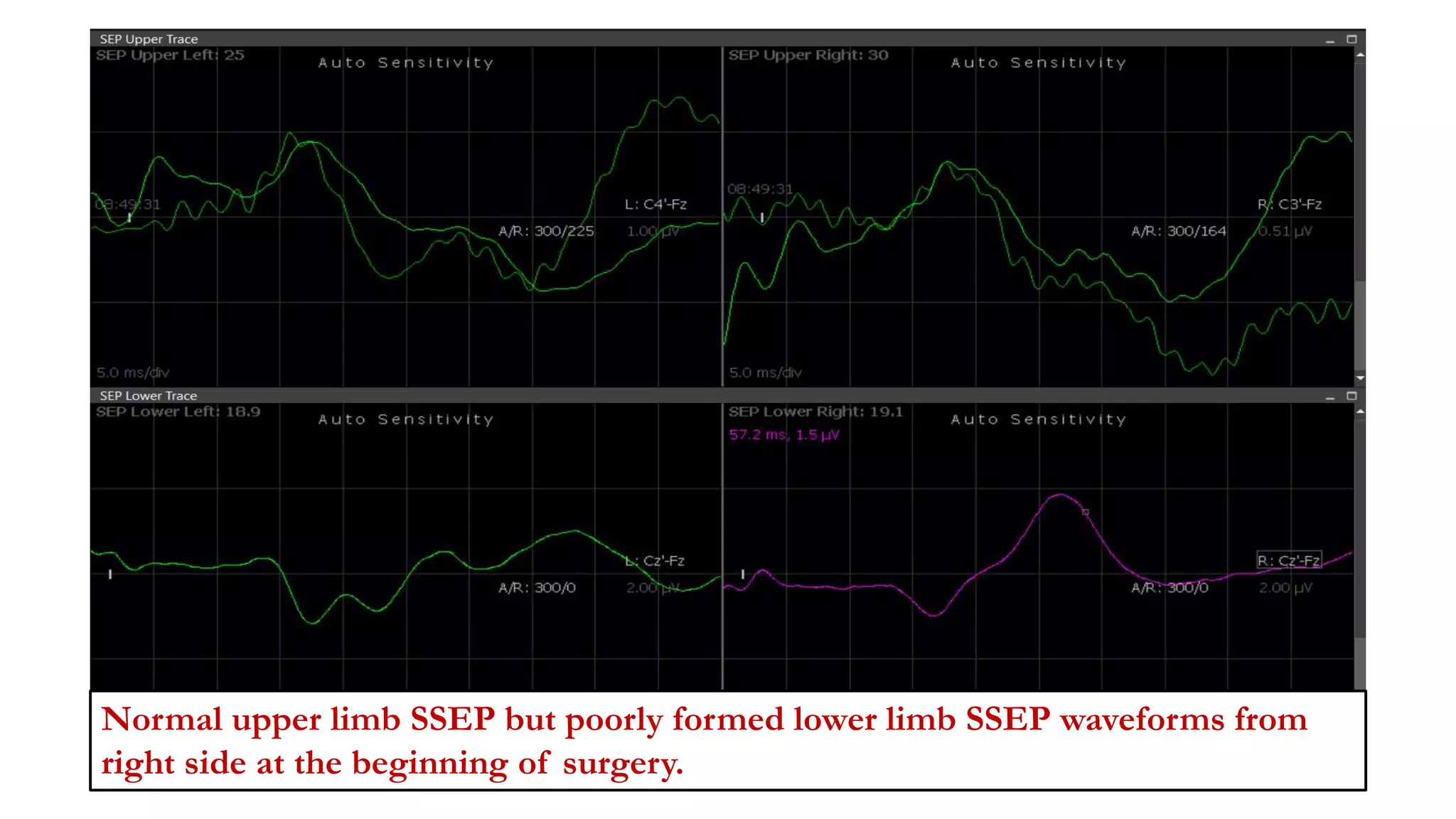 Normal upper limb SSEP but poorly formed lower limb SSEP waveforms from
right side at the beginning of surgery.
 