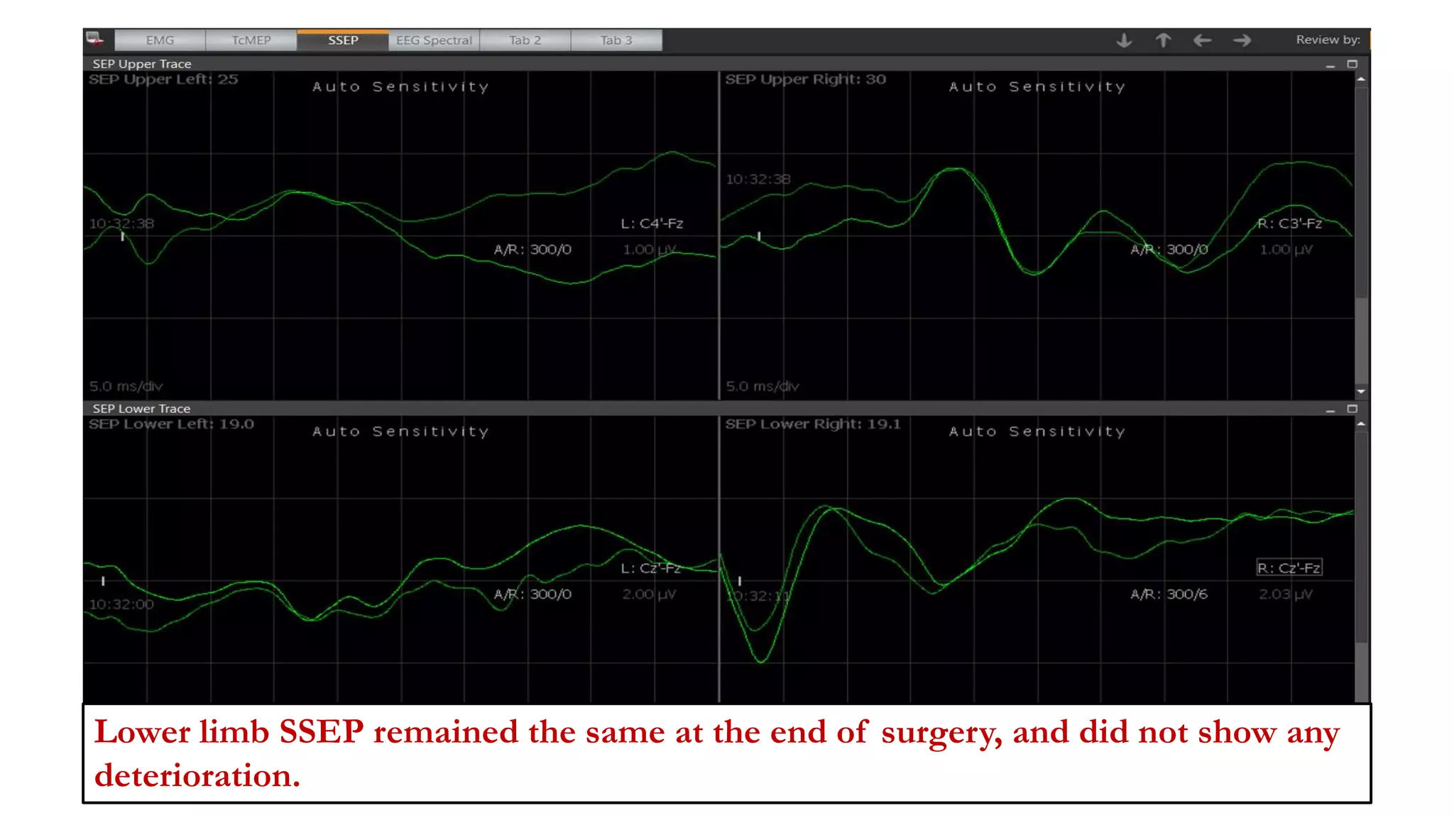 Lower limb SSEP remained the same at the end of surgery, and did not show any
deterioration.
 