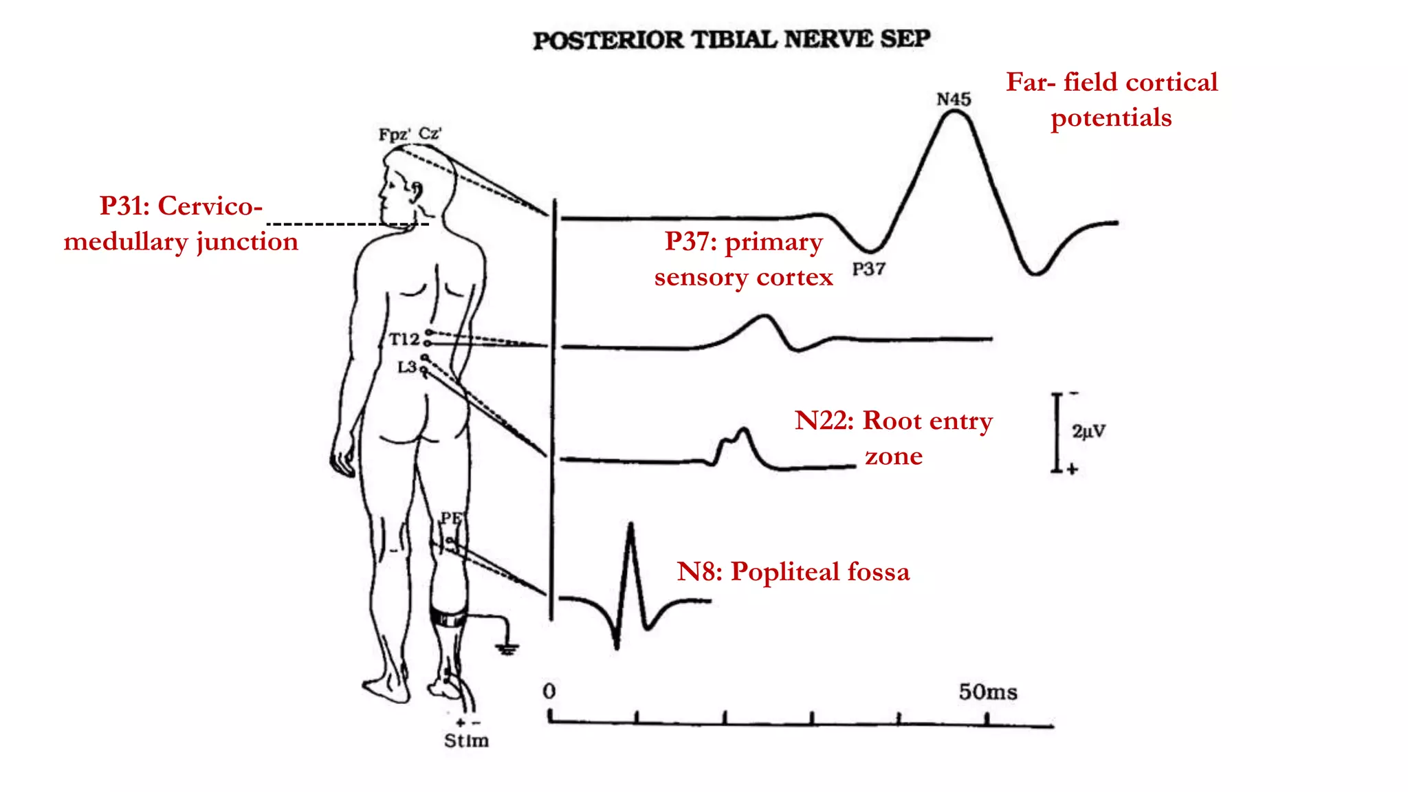 N8: Popliteal fossa
Far- field cortical
potentials
N22: Root entry
zone
P37: primary
sensory cortex
P31: Cervico-
medullary junction
 
