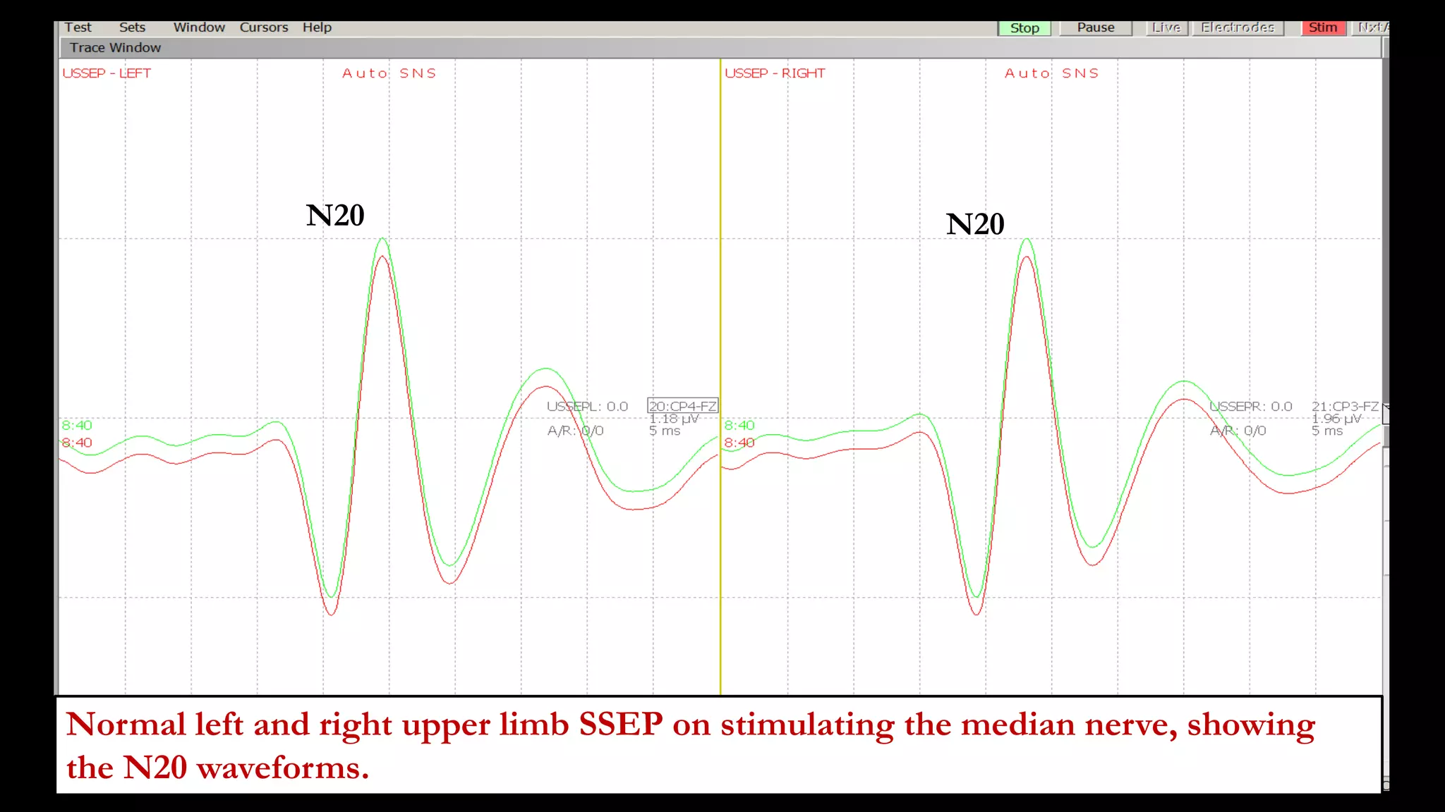 • .
Normal left and right upper limb SSEP on stimulating the median nerve, showing
the N20 waveforms.
N20 N20
 