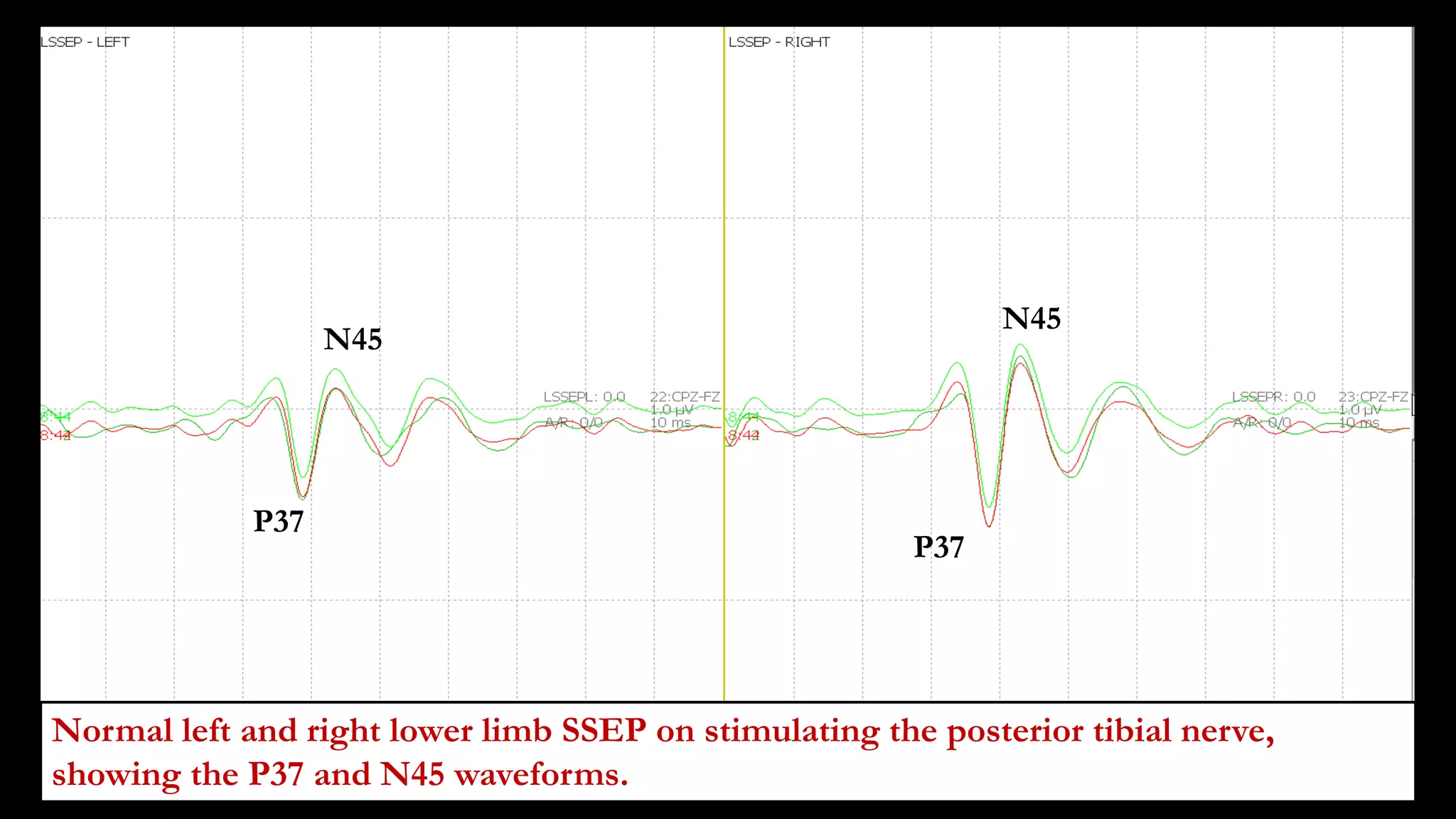 Normal left and right lower limb SSEP on stimulating the posterior tibial nerve,
showing the P37 and N45 waveforms.
P37
N45
P37
N45
 