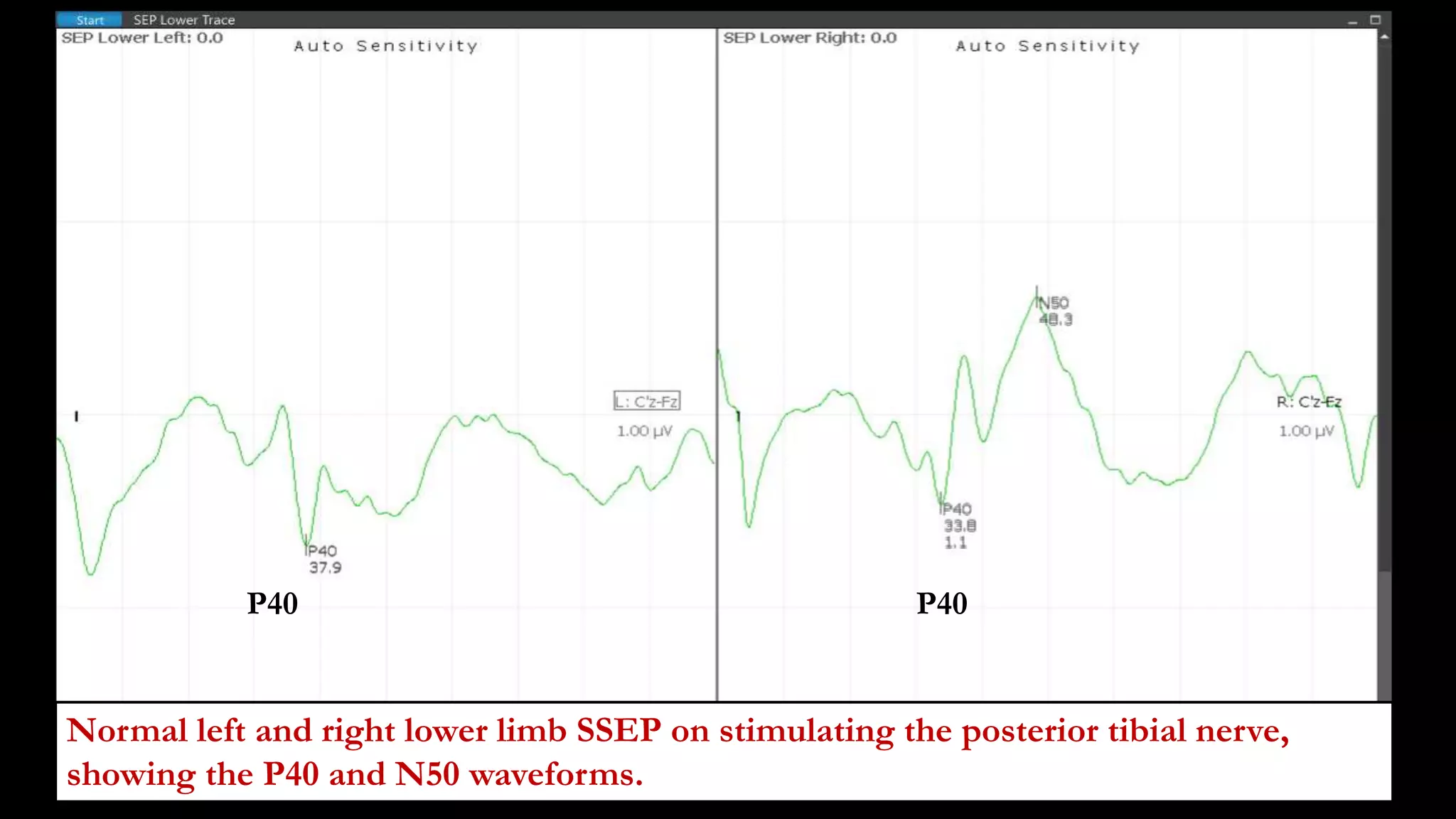 Normal left and right lower limb SSEP on stimulating the posterior tibial nerve,
showing the P40 and N50 waveforms.
P40 P40
 