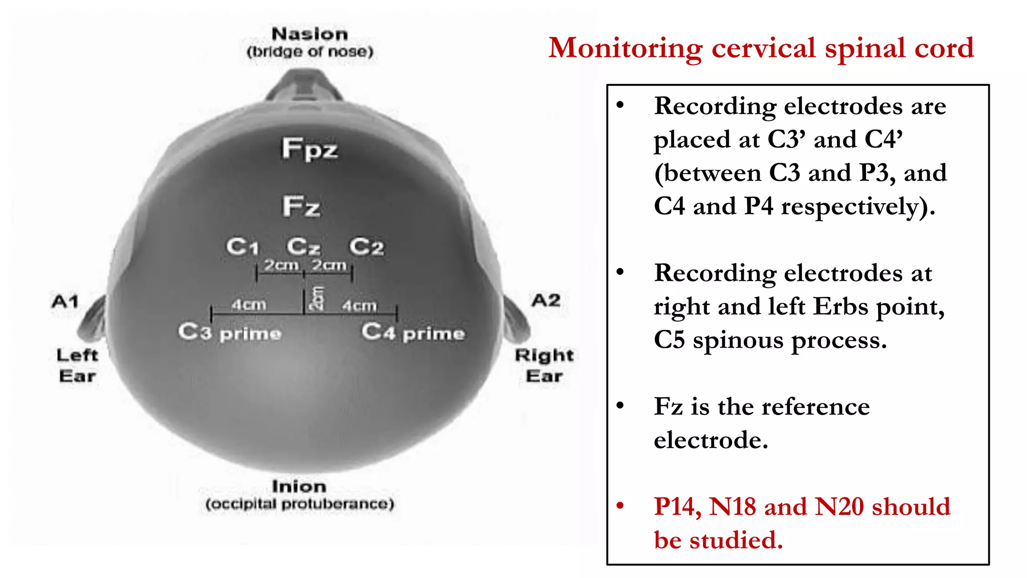 • Recording electrodes are
placed at C3’ and C4’
(between C3 and P3, and
C4 and P4 respectively).
• Recording electrodes at
right and left Erbs point,
C5 spinous process.
• Fz is the reference
electrode.
• P14, N18 and N20 should
be studied.
Monitoring cervical spinal cord
 