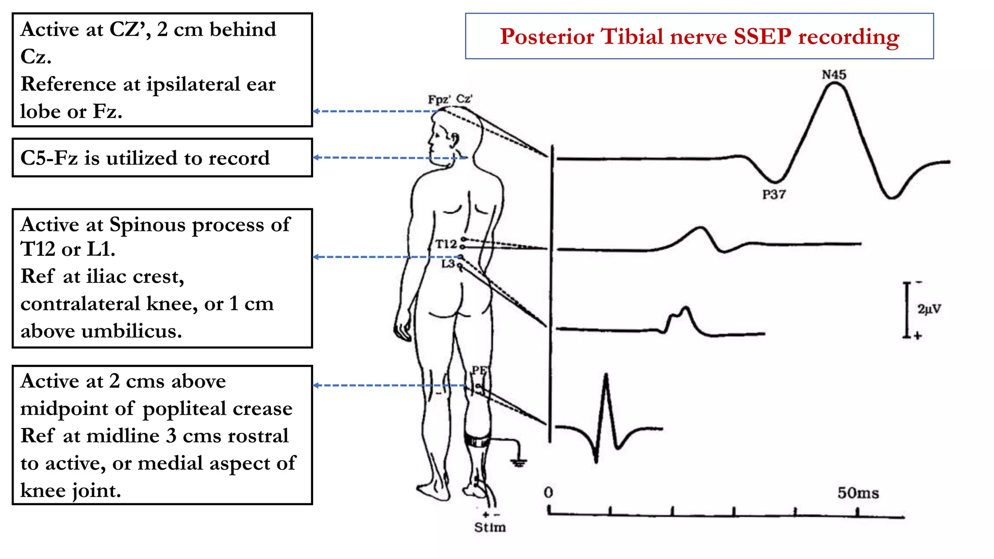 Active at 2 cms above
midpoint of popliteal crease
Ref at midline 3 cms rostral
to active, or medial aspect of
knee joint.
Active at Spinous process of
T12 or L1.
Ref at iliac crest,
contralateral knee, or 1 cm
above umbilicus.
Active at CZ’, 2 cm behind
Cz.
Reference at ipsilateral ear
lobe or Fz.
C5-Fz is utilized to record
Posterior Tibial nerve SSEP recording
 
