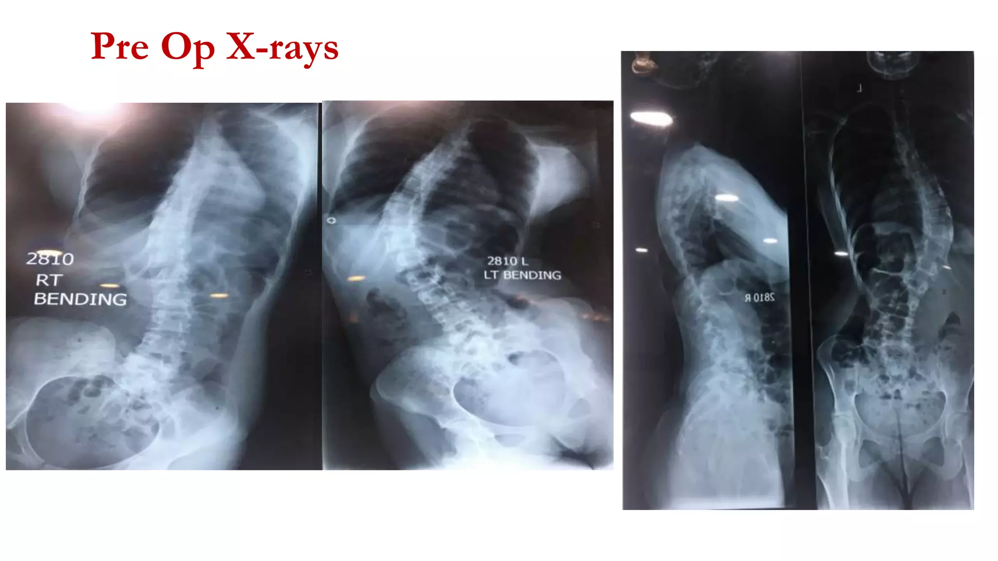 Pre Op X-rays
 