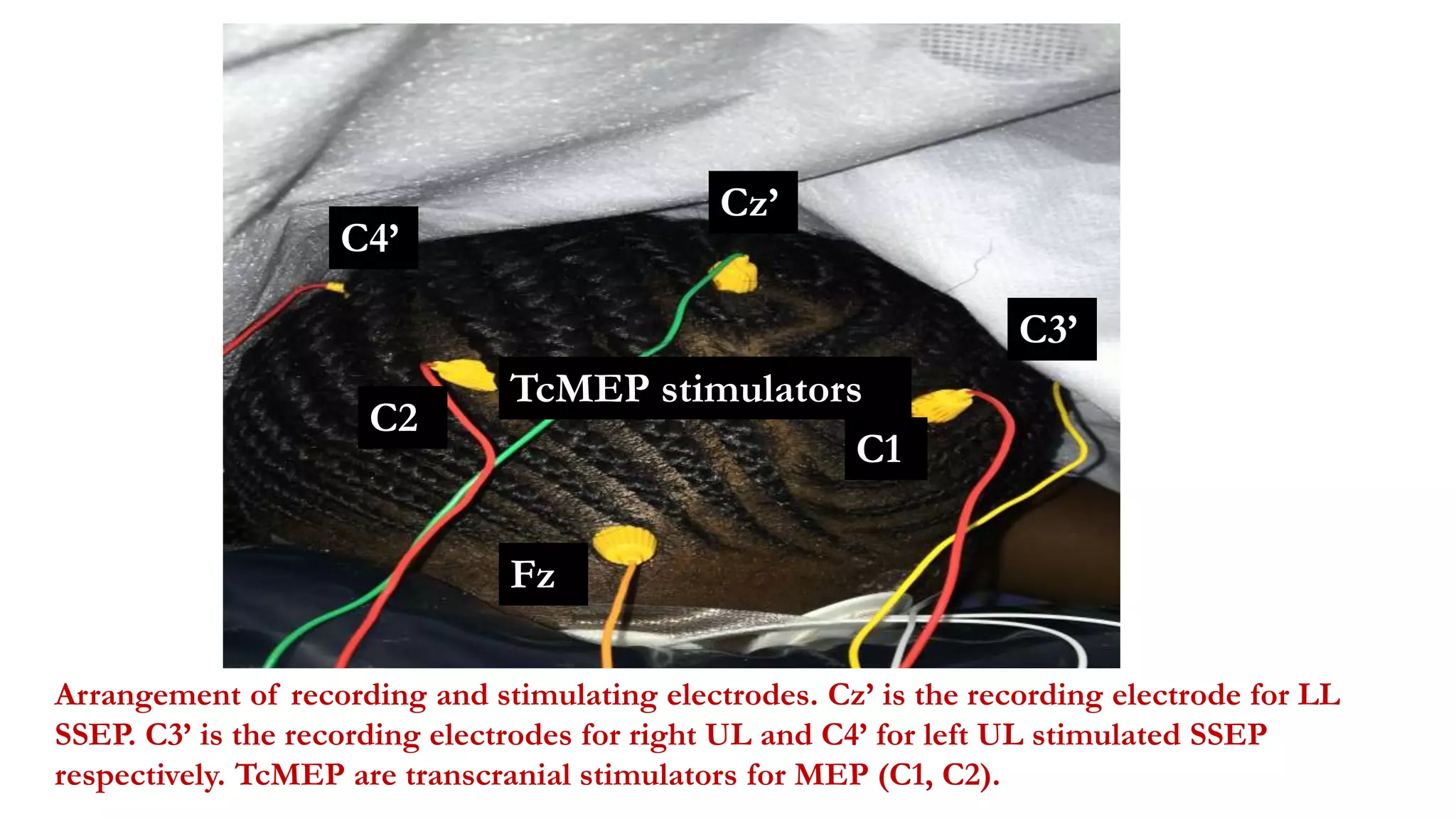 TcMEP stimulators
C4’
C3’
Cz’
Fz
Arrangement of recording and stimulating electrodes. Cz’ is the recording electrode for LL
SSEP. C3’ is the recording electrodes for right UL and C4’ for left UL stimulated SSEP
respectively. TcMEP are transcranial stimulators for MEP (C1, C2).
C1
C2
 