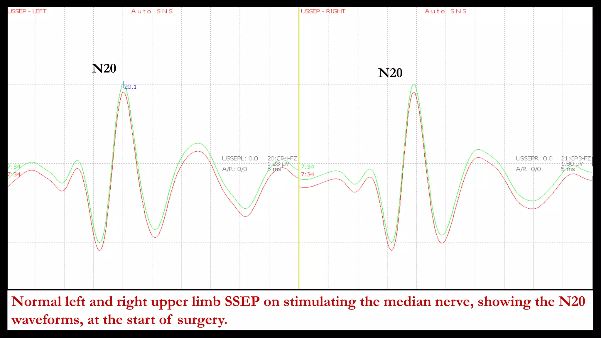 Normal left and right upper limb SSEP on stimulating the median nerve, showing the N20
waveforms, at the start of surgery.
N20 N20
 