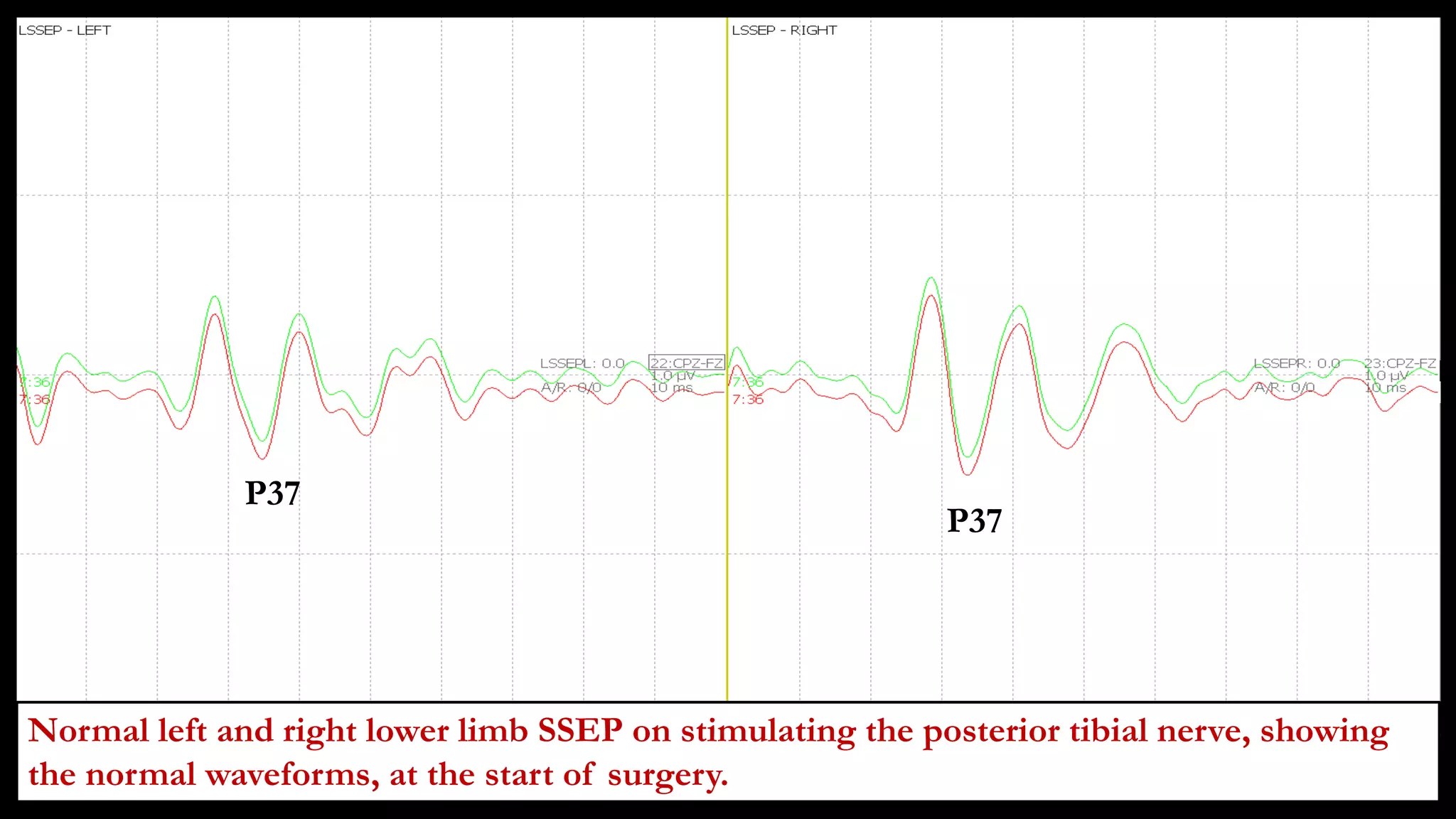Normal left and right lower limb SSEP on stimulating the posterior tibial nerve, showing
the normal waveforms, at the start of surgery.
P37
P37
 