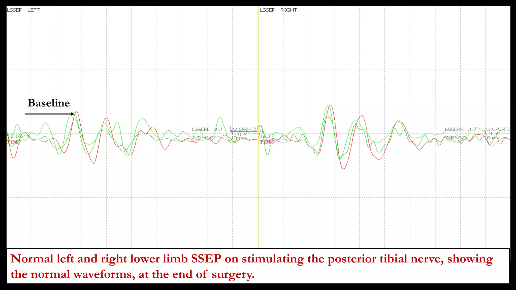 Baseline
Normal left and right lower limb SSEP on stimulating the posterior tibial nerve, showing
the normal waveforms, at the end of surgery.
 