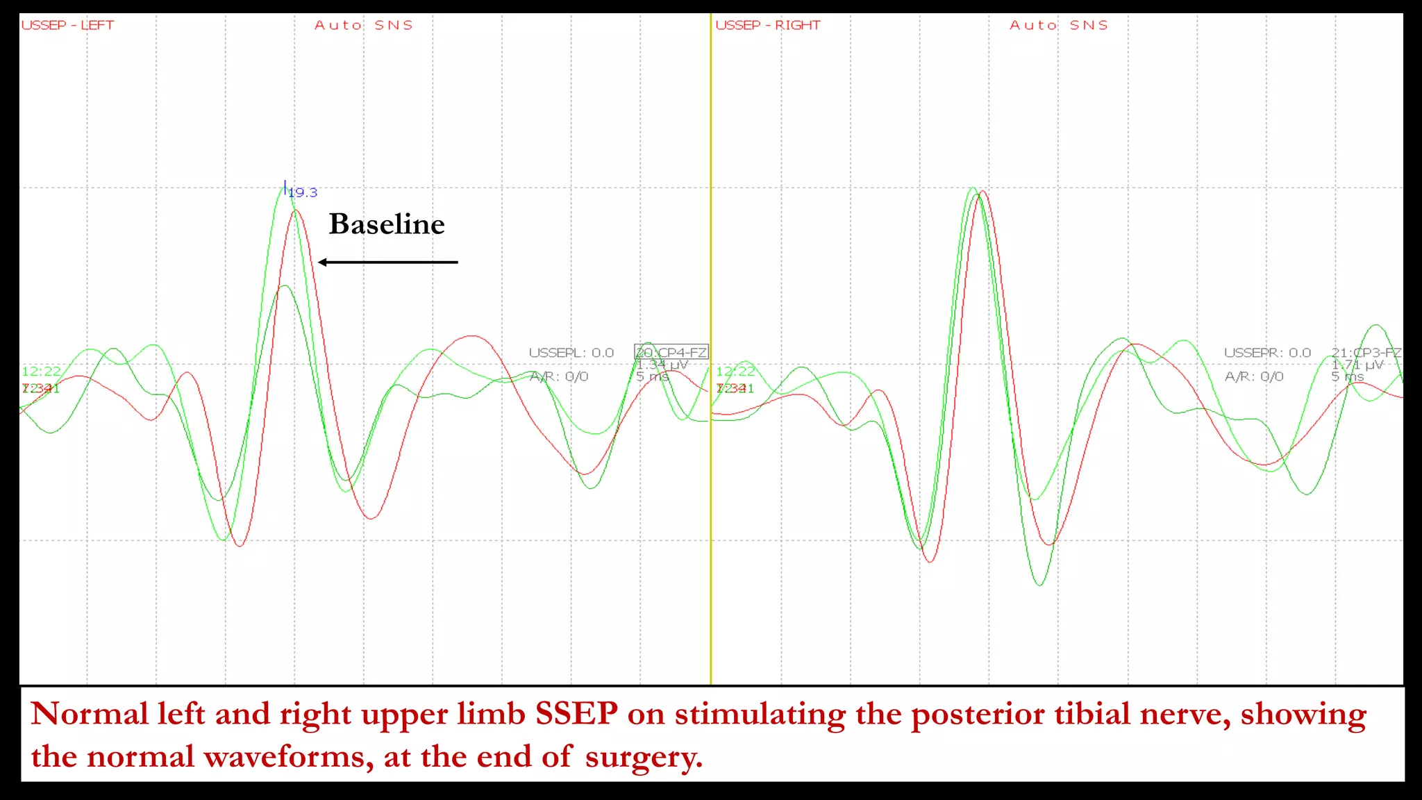 Baseline
Normal left and right upper limb SSEP on stimulating the posterior tibial nerve, showing
the normal waveforms, at the end of surgery.
 