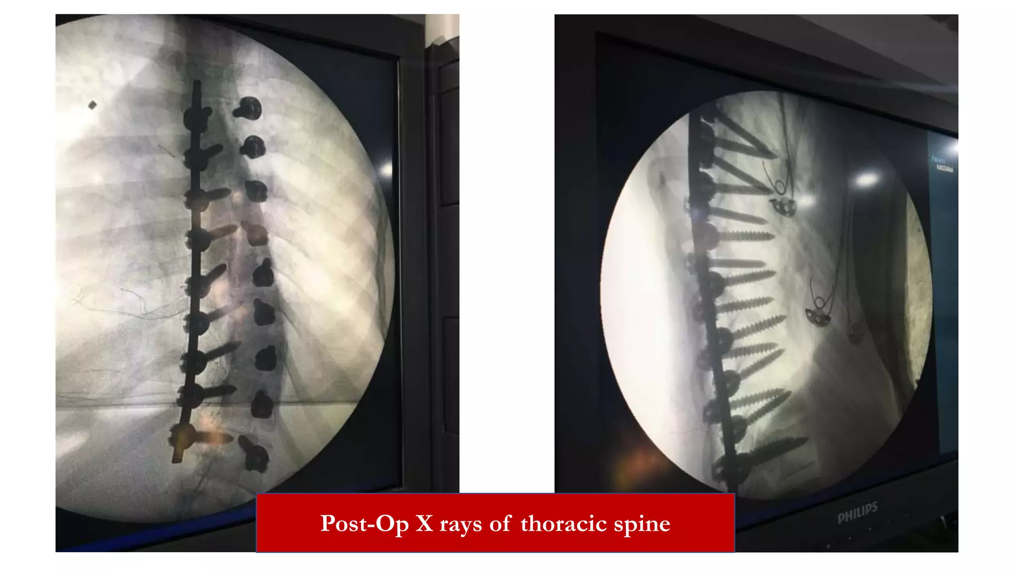 Post-Op X rays of thoracic spine
 