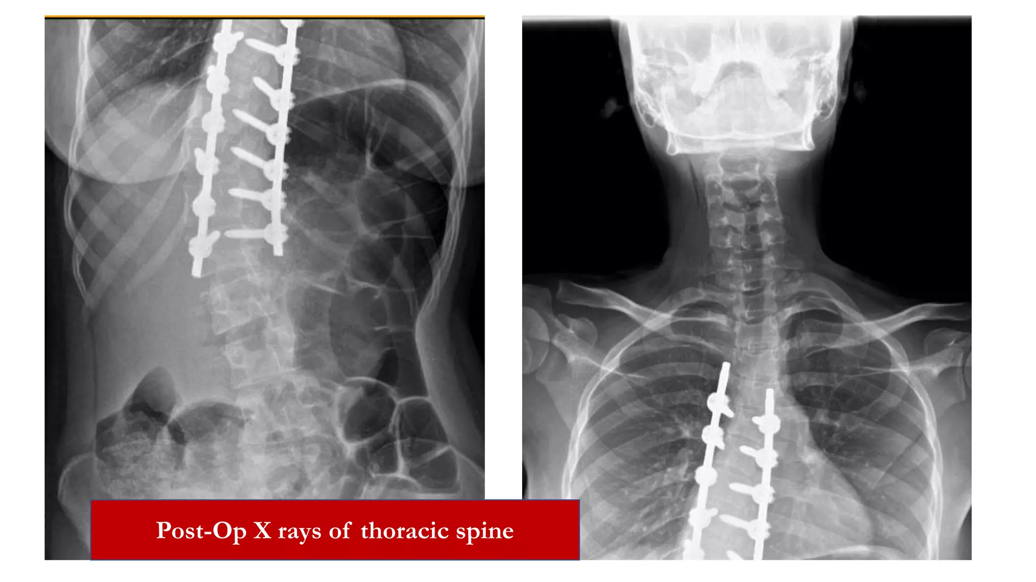 Post-Op X rays of thoracic spine
 